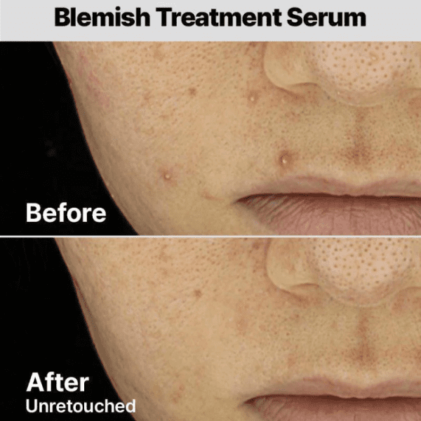 ضد جوش فوری کزرکس The AHA 2 BHA 2 Blemish Treatment Serum