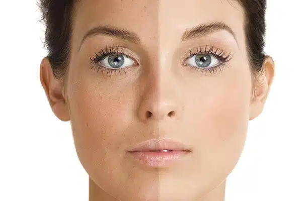 علت به وجود آمدن لک پوستی
